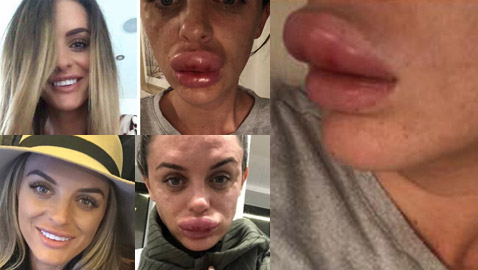 صور صادمة: البوتوكس يحول سيدة بريطانية جميلة الى مسخ
