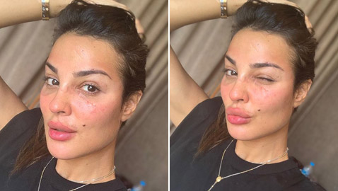 نادين نسيب نجيم تستعرض ندوبها بدون فلتر.. وهذا موعد ظهورها على التلفاز