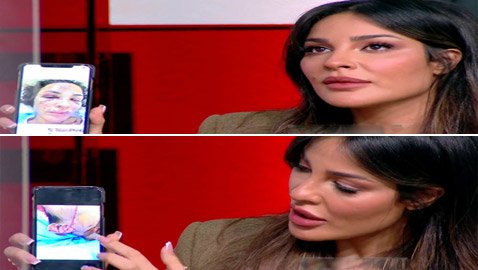 نادين نسيب نجيم تكشف عن صور وجهها المشوه لأول مرة بعد انفجار بيروت
